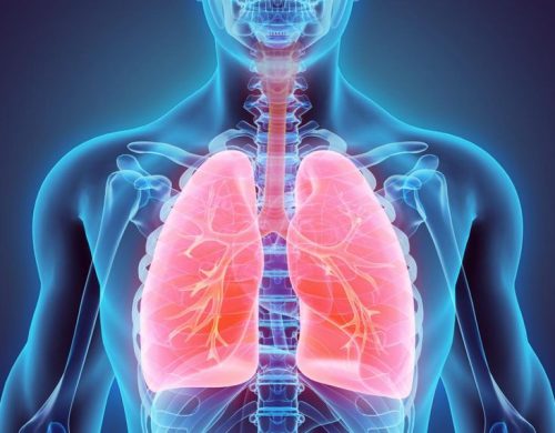 Acute respiratory distress syndrome (Wet lung)